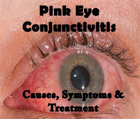 what is its pink|Pink eye (conjunctivitis) .